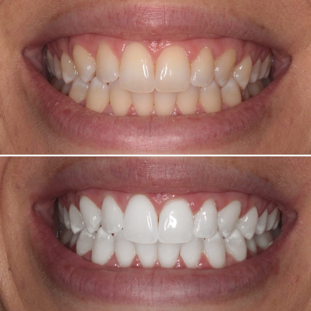 Teeth Whitening celina tx open late dentistry Dr. Rouse