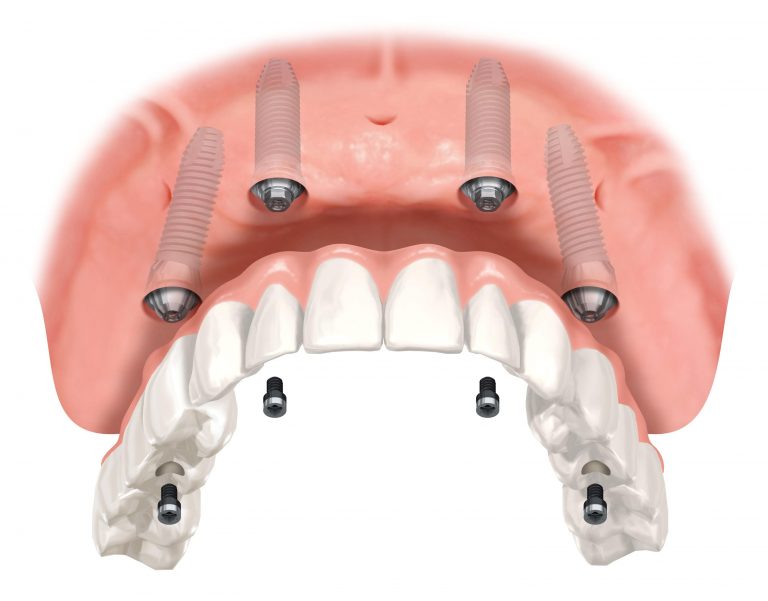 ALL 4 ON 4 Implant Placement in Prosper, Gunter, Celina Dr. Rouse