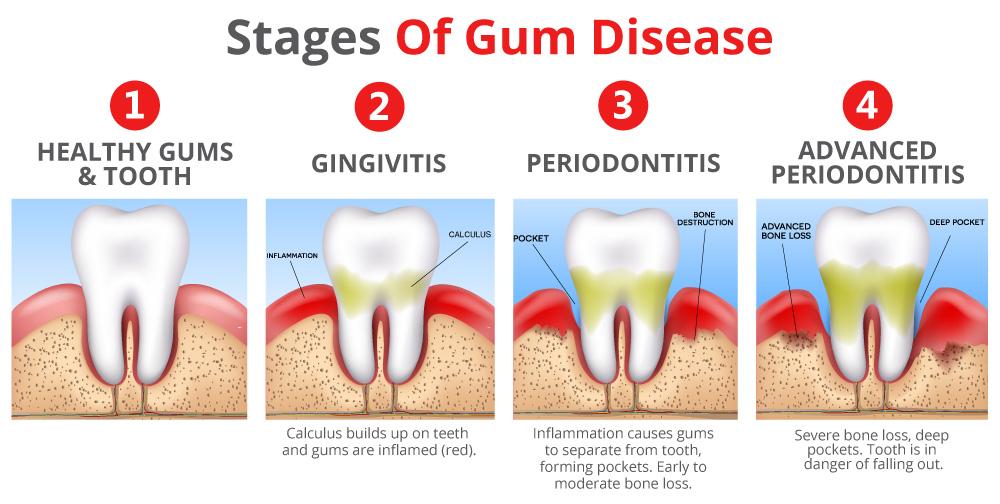 Gum Disease Therapy in Celina, TX at Open Late Dentistry