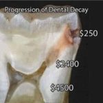 Affordable Tooth Colored Fillings Celina Texas Tx Dr Rouse