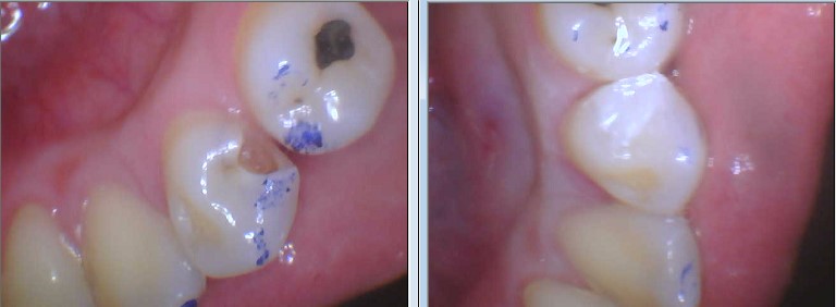 Before And After Cavity Tooth Colored Filling Celina Texas Tx Dr Rouse