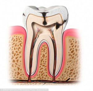 Root Canal Therapy Celina Tx Dr Rouse Open Late Dentistry And Orthodontics Cracked Broken Tooth