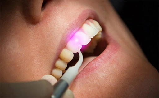 Deep Cleaning Laser Dr Rouse Open Late Dentistry Prosper Celina Frisco Mckinney