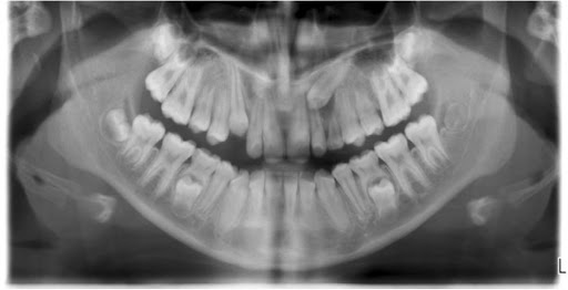 Phase 1 Impacted Canines Orthodontics Dr Rouse Open Late Dentistry Prosper Celina Frisco Mckinney