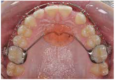 Phase 1 Permanent Upper Retainer Orthodontics Dr Rouse Open Late Dentistry Prosper Celina Frisco Mckinney