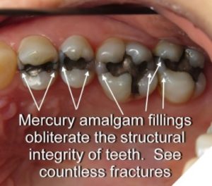 Silver Mercury Fillings Cracks Dr Rouse Open Late Dentistry Prosper Celina Frisco Mckinney