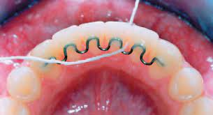 Permanent V Loop Retainer Orthodontics Dr Rouse Open Late Dentistry Prosper Celina Frisco Mckinney