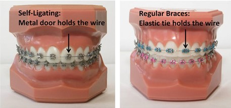 Self Ligating Brackets Open Late Dentistry And Orthodontics Celina Prosper Tx