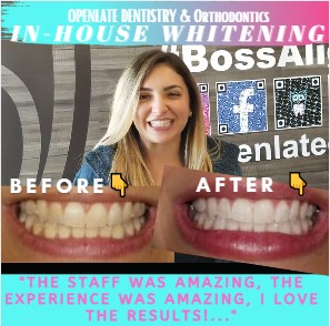 Kor Night Whitening Dr Rouse Celina Prosper Teeth Whitening Open Late Dentistry And Orthodontics