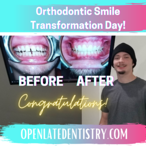 Smile Makeover Celina Gunter Prosper TX Dr. Rouse Open Late Dentistry and Orthodontics