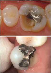 Dental Crowns Fractured Teeth Celina Prosper Gunter Texas Tx Dr Rouse Open Late Dentistry And Orthodontics