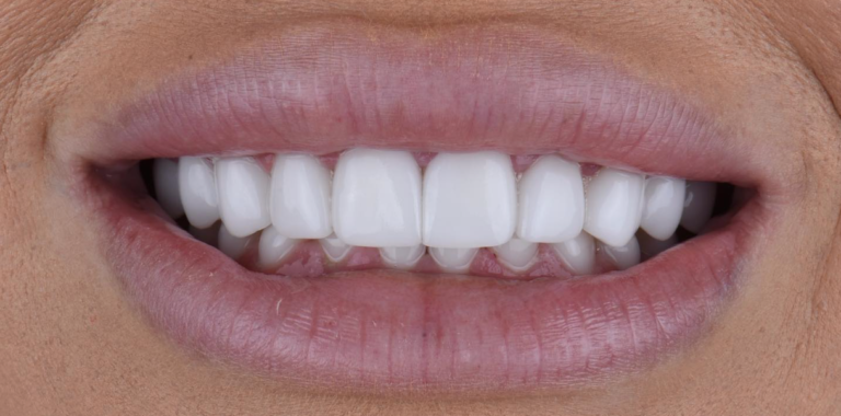 Low Translucency (Hollywood Look) Prosper Celina TX Plano Dallas Frisco Dr. Rouse Open Late Dentistry