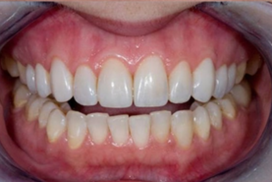 Natural Veneers Celina Prosper Frisco Plano TX Dr Rouse Open Late Dentistry