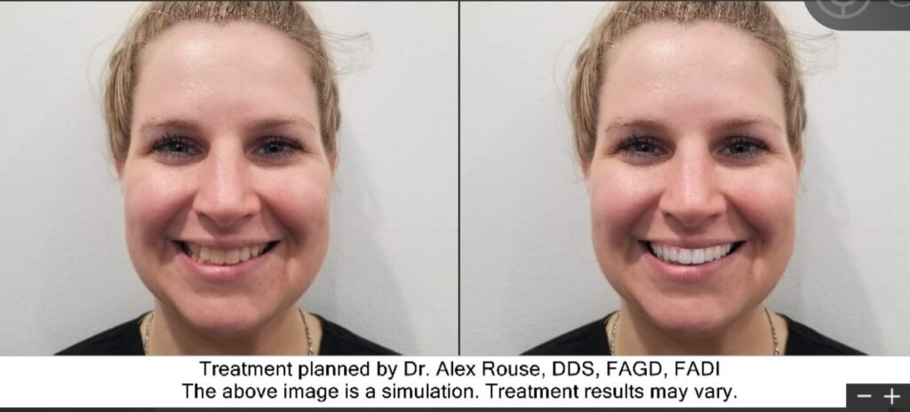 Smile Makeover Celina TEXAS Dr. Rouse Open Late Dentistry and Orthodontics Veneers Dental